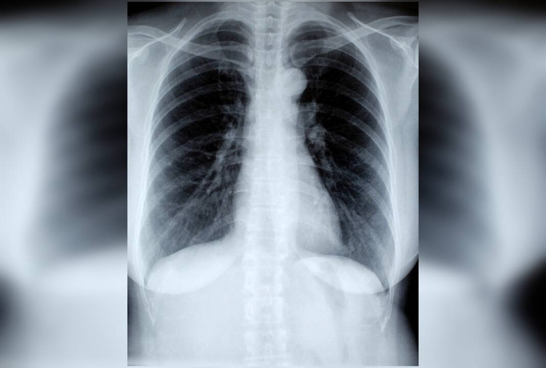 Diagnozė: plaučių vėžys – dažniausia onkologinė liga pasaulyje, 90 proc. žmonių ja suserga dėl tabako rūkymo.