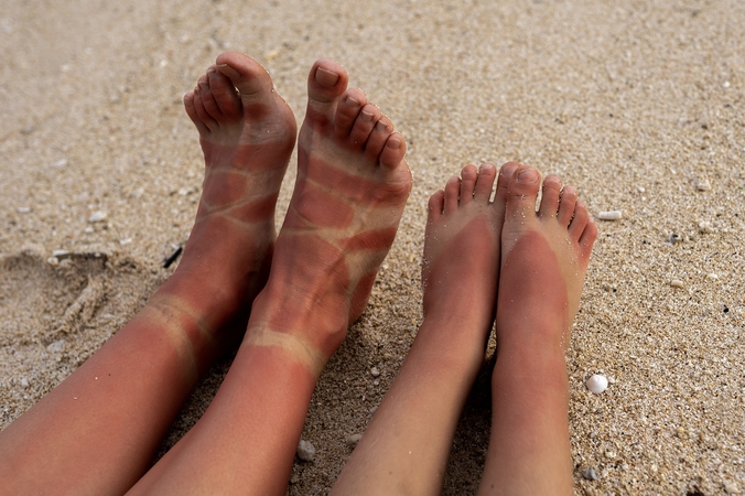 Pastebi neatsakingą lietuvių elgesį: atostogaudami karštose šalyse nudega net pėdas